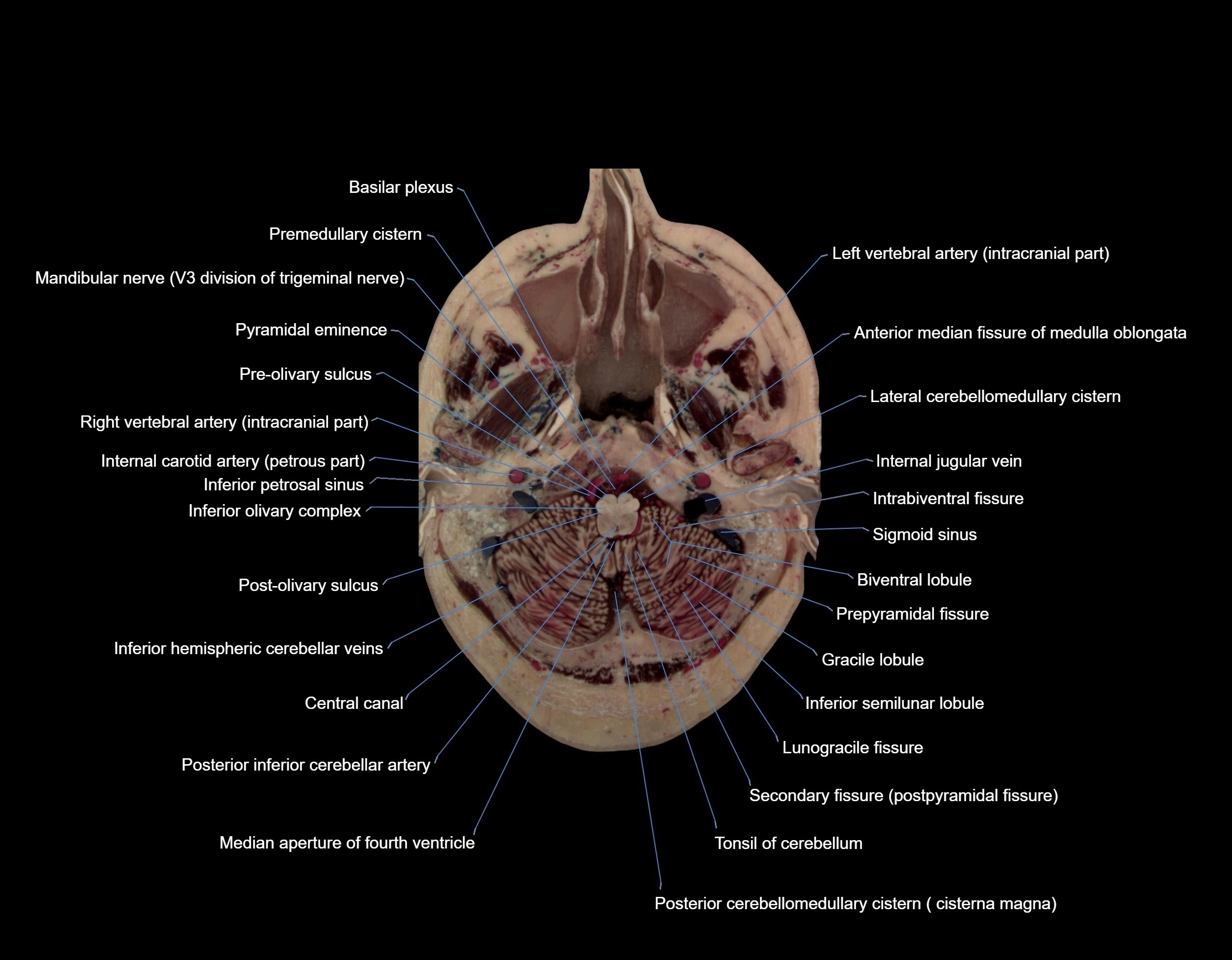 MRI Brain axial cross sectional radiology anatomy 3T image  -img-00008.webp